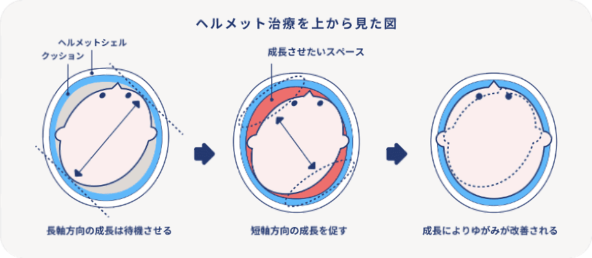 ヘルメット治療を上から見た図