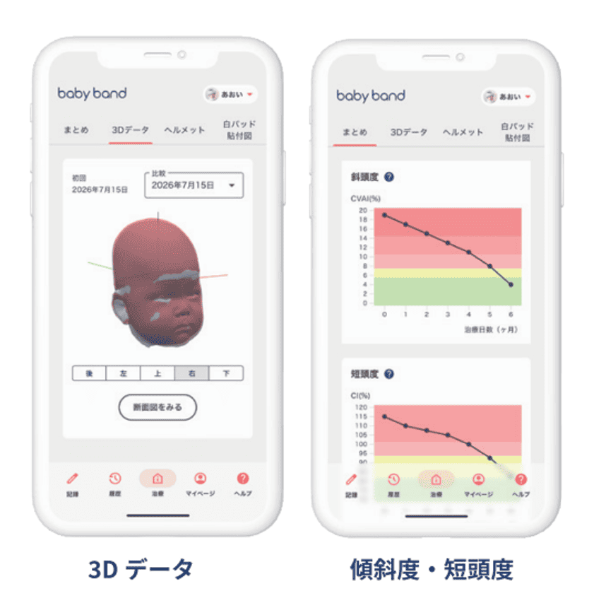 3Dデータや傾斜度、短頭度が表示されたアプリの画面